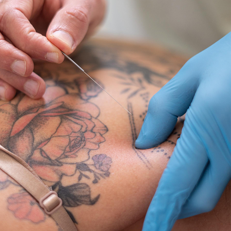 Dry needling Mouscron - Studio Santé